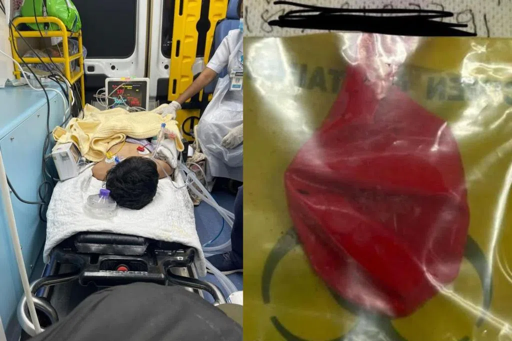 A New Zealand teenager swallowed hundreds of powerful magnets, causing partial intestinal necrosis.